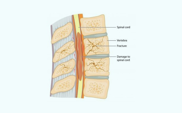 Spinal Fracture Surgery