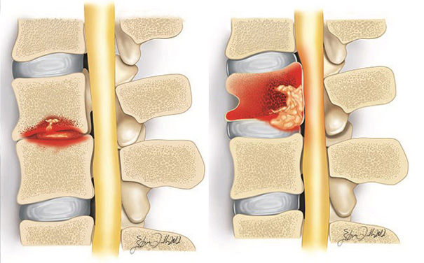 Spinal Infections Surgery