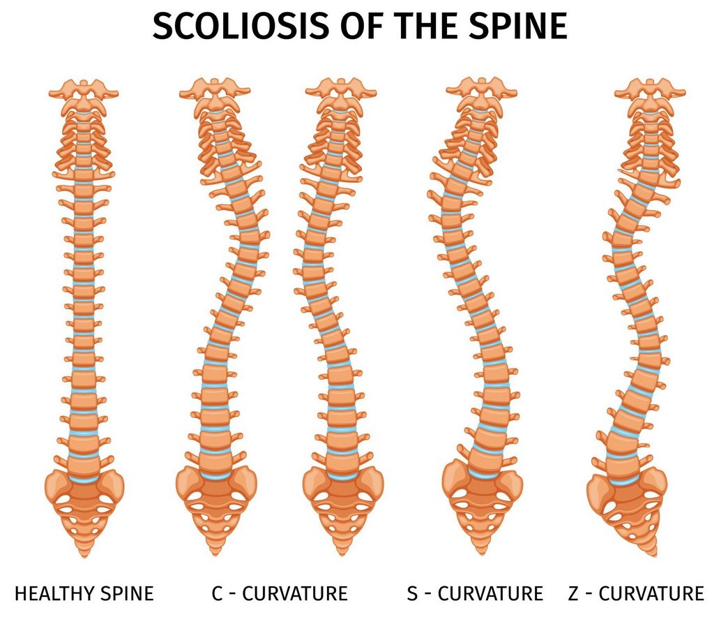 Best Scoliosis Treatment in Mumbai