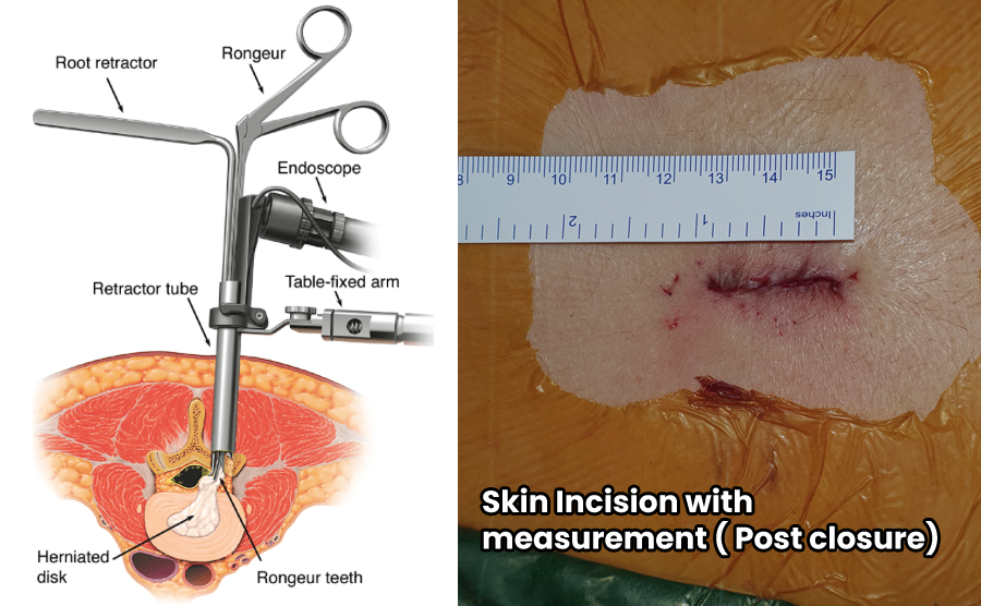 Microdiscectomy Surgery in Mumbai Home | Treatments | Surgical | Endoscopic Microdiscectomy