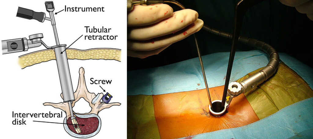 Advanced Spine Care by Expert Minimally Invasive Spine Surgeons