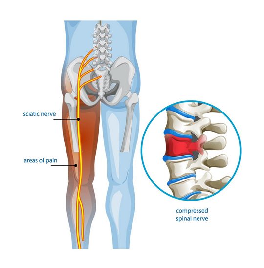 Sciatica