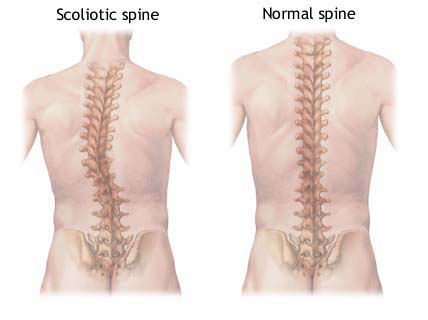 Scoliosis