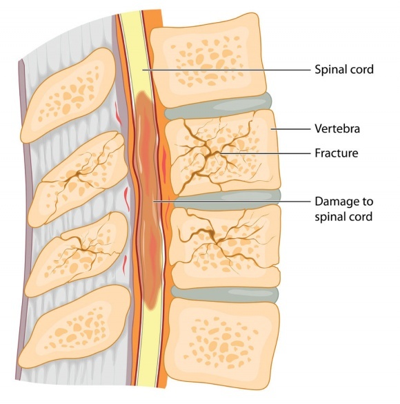 Spinal Fracture Surgery