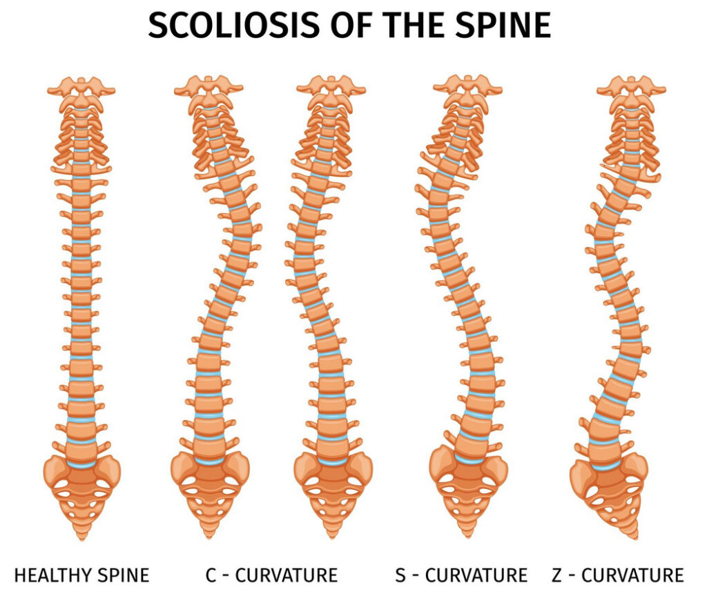 scoliosis